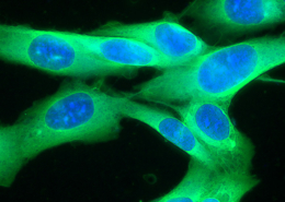 Picture of a human melanoma cell line growing in tissue culture