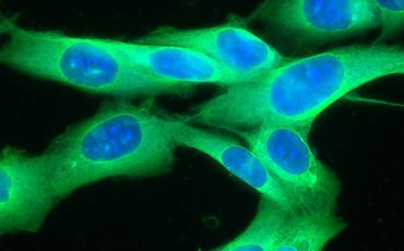 Picture of a human melanoma cell line growing in tissue culture