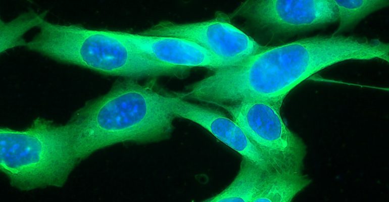 Picture of a human melanoma cell line growing in tissue culture