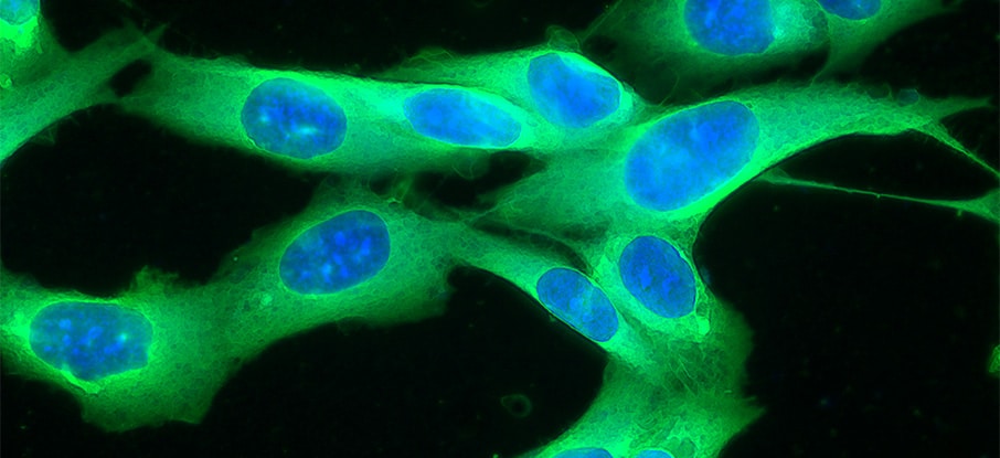 Picture of a human melanoma cell line growing in tissue culture